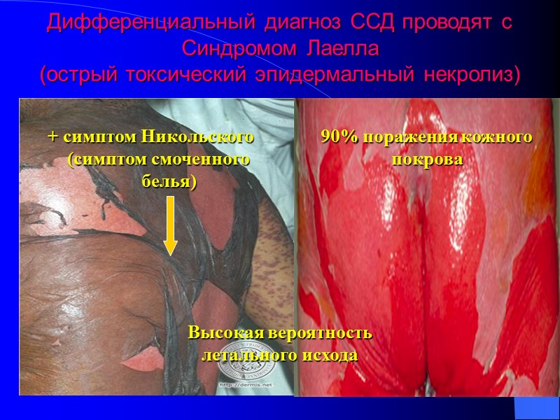 Дифференциальный диагноз ССД проводят с Синдромом Лаелла  (острый токсический эпидермальный некролиз) + симптом